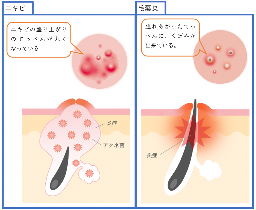 毛嚢炎とニキビの比較イラスト